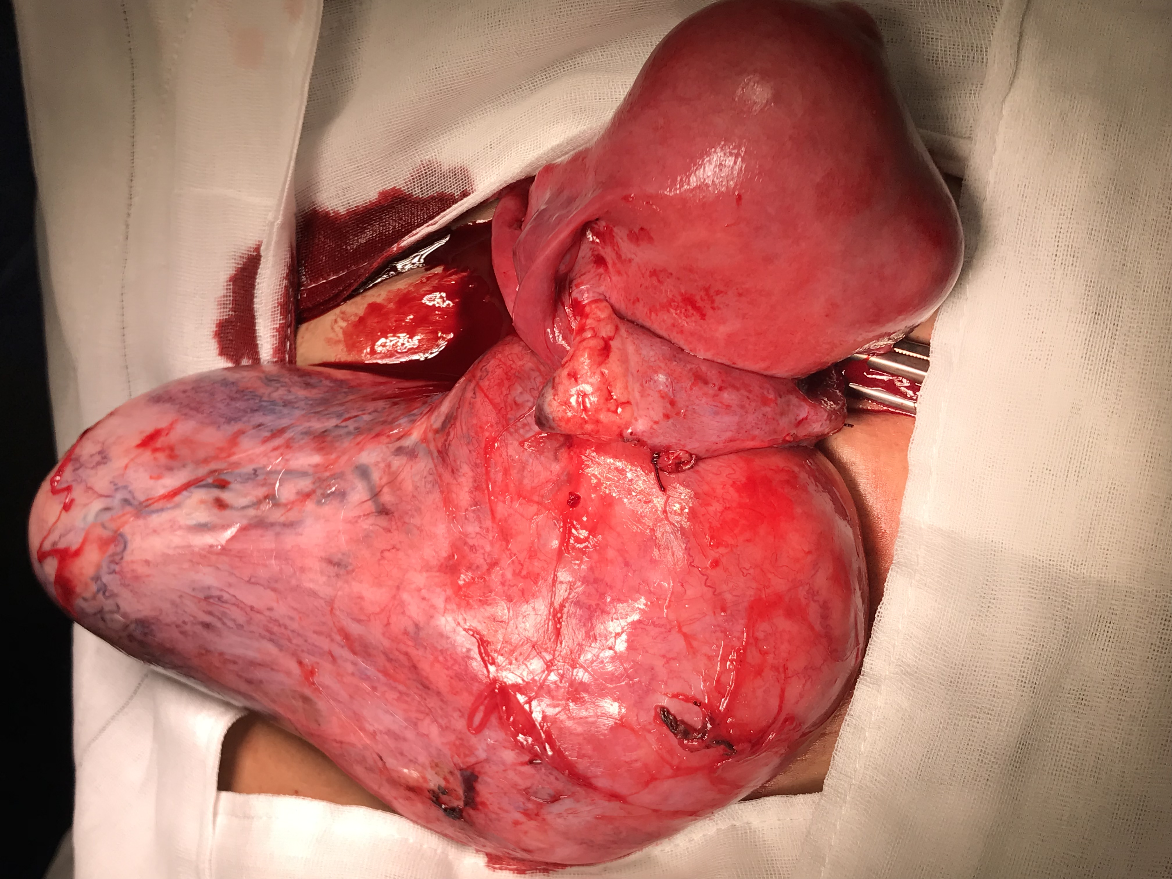 Dr Serag Youssif Fibroid Very Large Herniating Through Pelvic Floor3